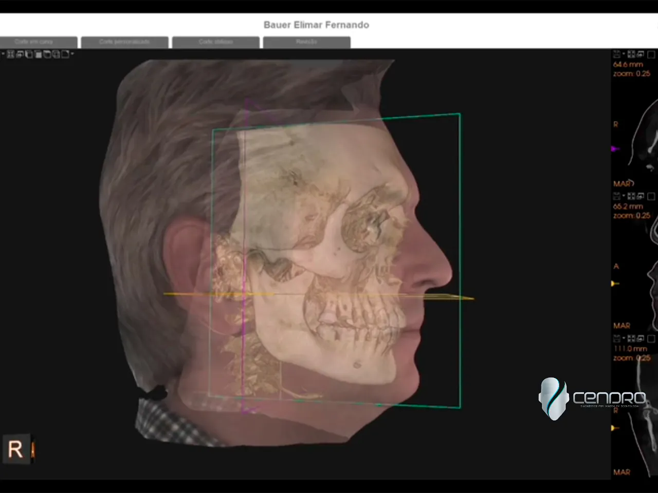 Tela de software com escaneamento facial 3D sobreposto à tomografia