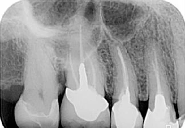 Radiografia periapical digital mostrando dentes, raízes e osso de suporte
